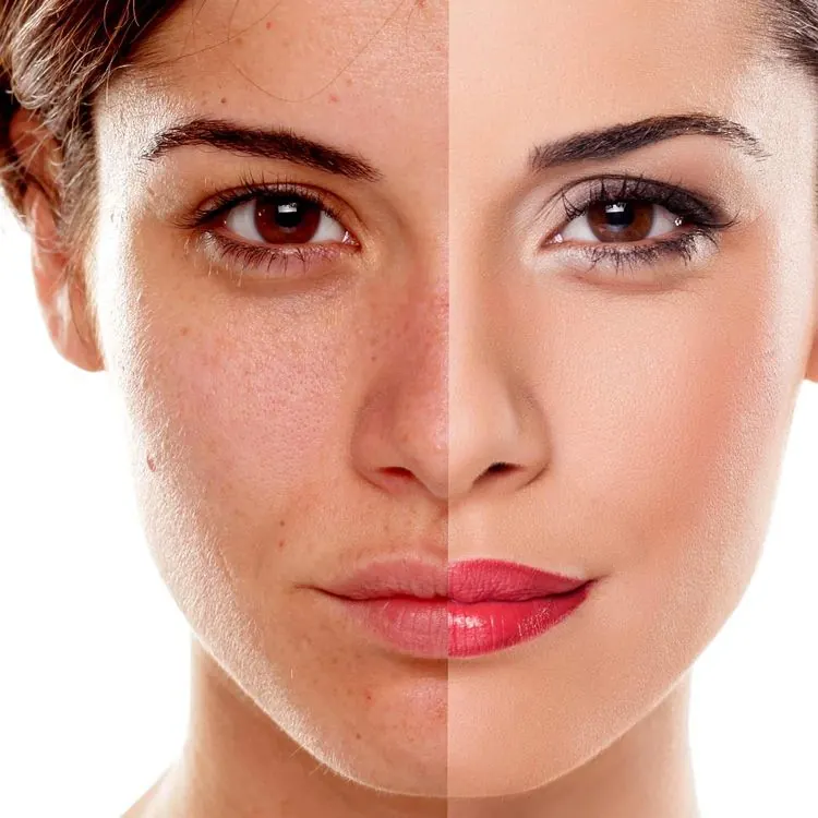 Skin Pigmentation Treatment treatment at Kira Exotica, a beauty salon in Indore